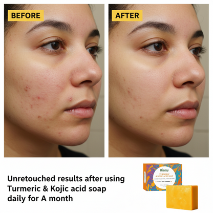 Hiemy Turmeric & Kojic Acid Brightening Soap | Fades Dark Spots & Evens Skin Tone (Combo of 3 Soap)